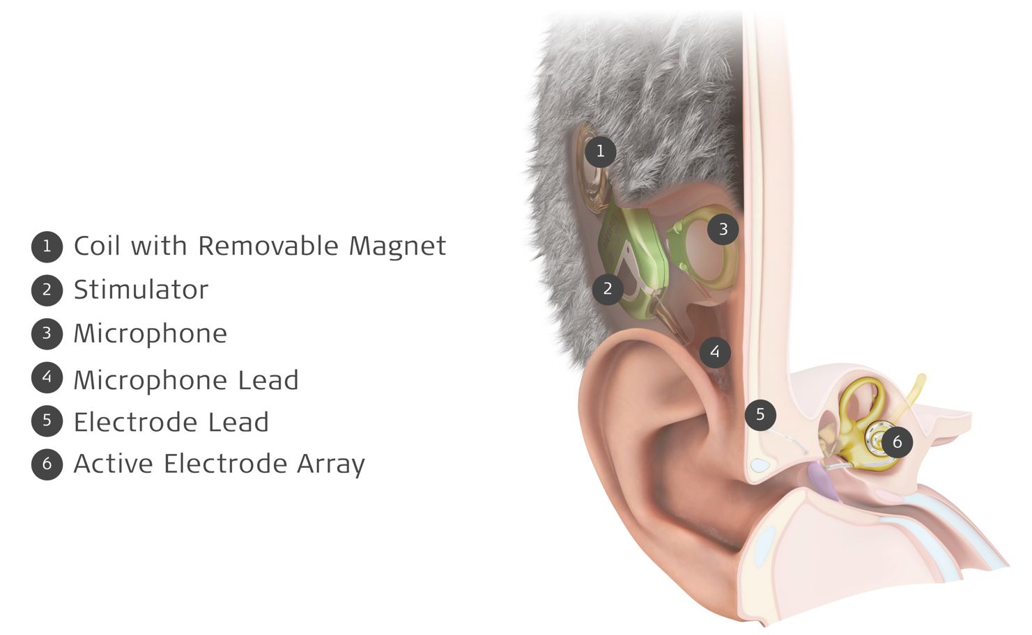 MED-EL lance TICI UNICO Anatomy